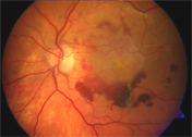 DMRI, degeneracao macular relacionada a idade