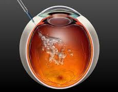 DMRI, degeneracao macular relacionada a idade